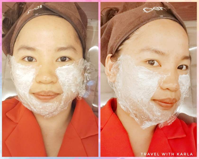 Face Thread Lift in Korea
